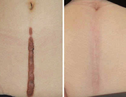 🇯🇵Japan♥HISAMITSU Hisamitsu Ogawa Scar Repair and Removal Patch
 HISAMITSU Eclar Plaster Keloid Scar Remover \ Any scar savior! Hong Kong doctors recommend scar removal patches/
 Hisamitsu's 薬エクラープラスター 20μg/cm2