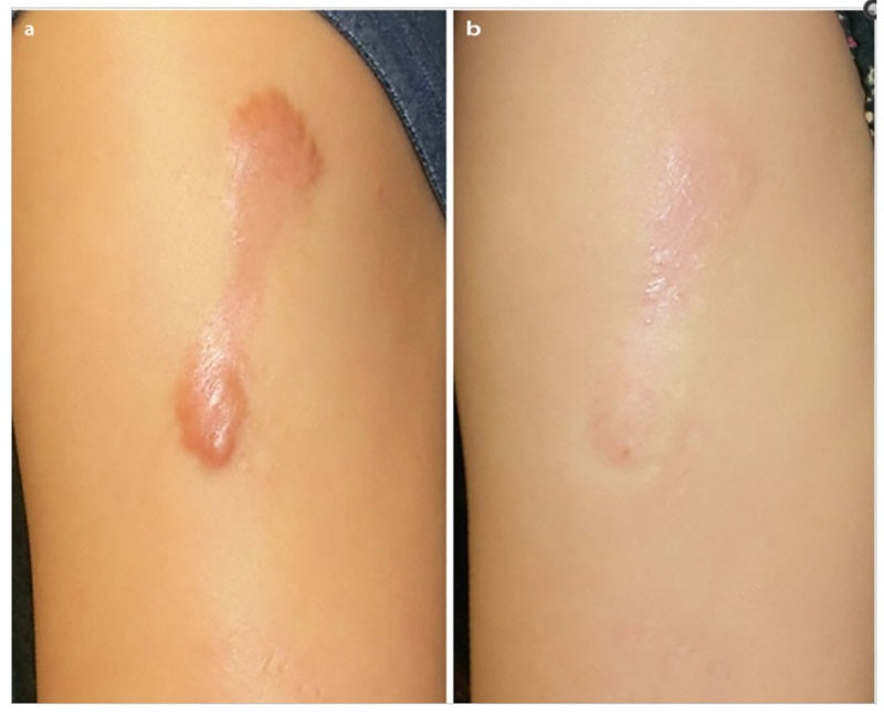 🇯🇵Japan♥HISAMITSU Hisamitsu Ogawa Scar Repair and Removal Patch
 HISAMITSU Eclar Plaster Keloid Scar Remover \ Any scar savior! Hong Kong doctors recommend scar removal patches/
 Hisamitsu's 薬エクラープラスター 20μg/cm2