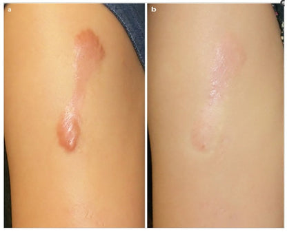 🇯🇵Japan♥HISAMITSU Hisamitsu Ogawa Scar Repair and Removal Patch
 HISAMITSU Eclar Plaster Keloid Scar Remover \ Any scar savior! Hong Kong doctors recommend scar removal patches/
 Hisamitsu's 薬エクラープラスター 20μg/cm2