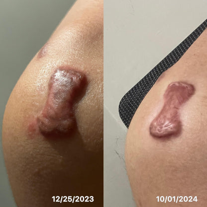 🇯🇵Japan♥HISAMITSU Hisamitsu Ogawa Scar Repair and Removal Patch
 HISAMITSU Eclar Plaster Keloid Scar Remover \ Any scar savior! Hong Kong doctors recommend scar removal patches/
 Hisamitsu's 薬エクラープラスター 20μg/cm2